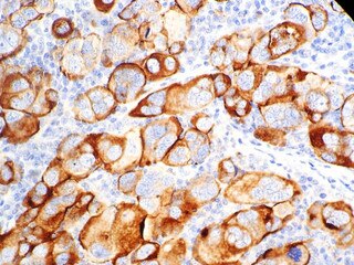IHC of CA-125 on an FFPE Ovarian Carcinoma Tissue